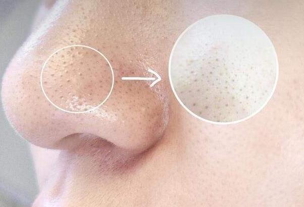 脸部忽然长脓包疙瘩不疼,丘疹脓包型痘痘留下的疤怎么消除