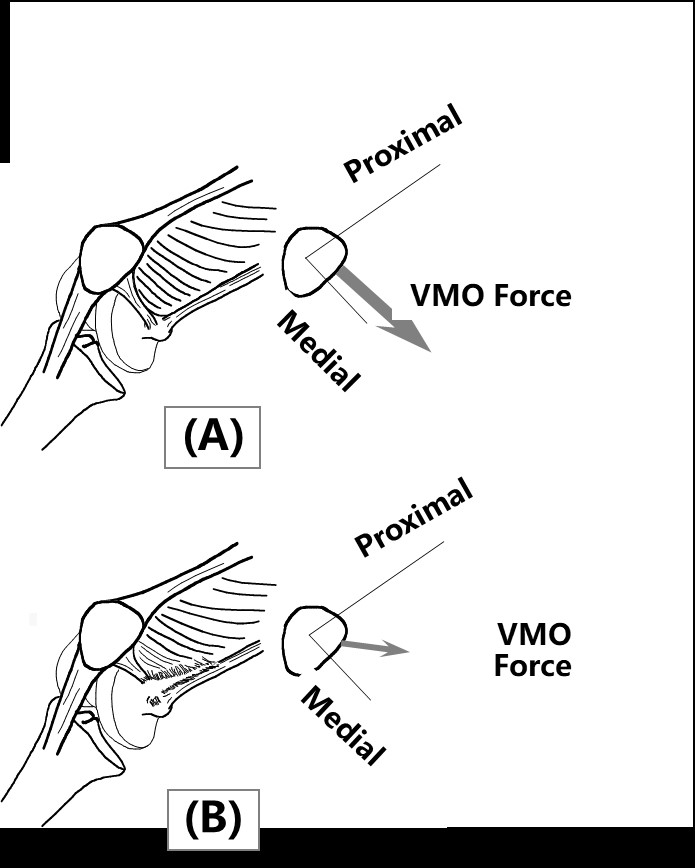 髌骨半脱位打石膏能彻底治愈吗,青少年髌骨脱位还能长高吗