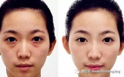 卧蚕整形可以去眼袋吗,眼袋和卧蚕整形前后对比