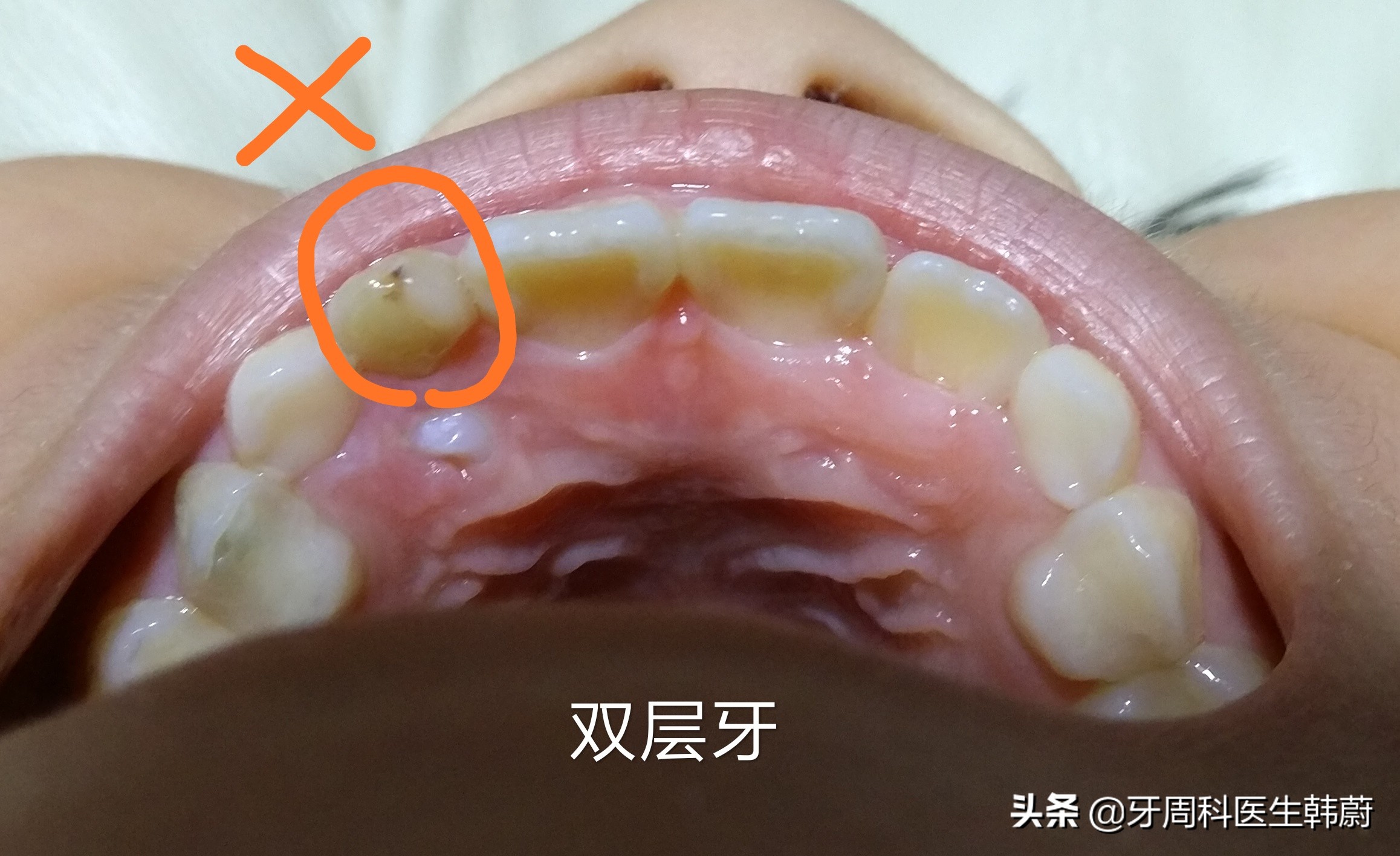 宝宝长双层牙乳牙怎么拔掉,6岁小孩长双层牙必须拔掉吗