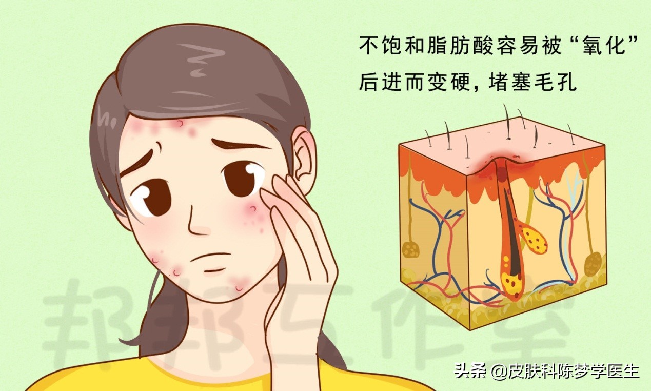 导致痘痘的成分有哪些,导致痘痘的护肤品成分有哪些