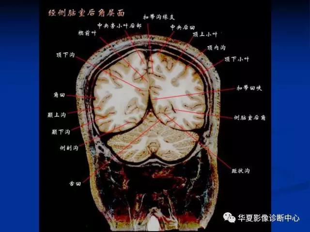 电子版头颅ct与mri断层解剖,头颅mri血管解剖与分段详解