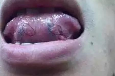 舌头一旦出现这个信号马上找中医,舌头一旦出现这个信号马上去医院