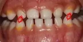 什么叫地包天怎么治疗,什么叫地包天能矫正吗