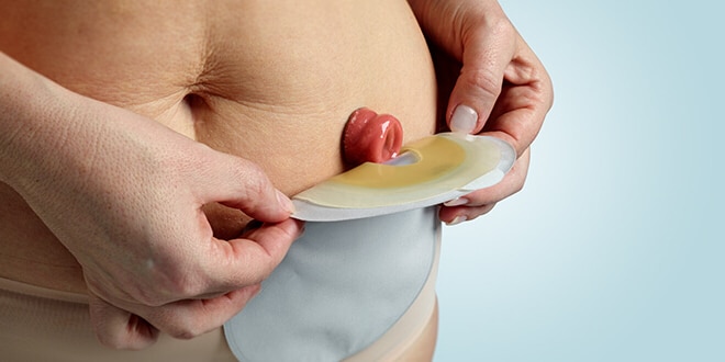 肠癌引起肠梗阻最佳中医治疗方法,肠癌引起的肠梗阻如何治疗