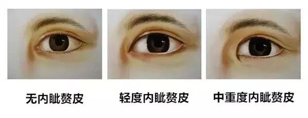 网红眼睛开眼角,做过开眼角的网红