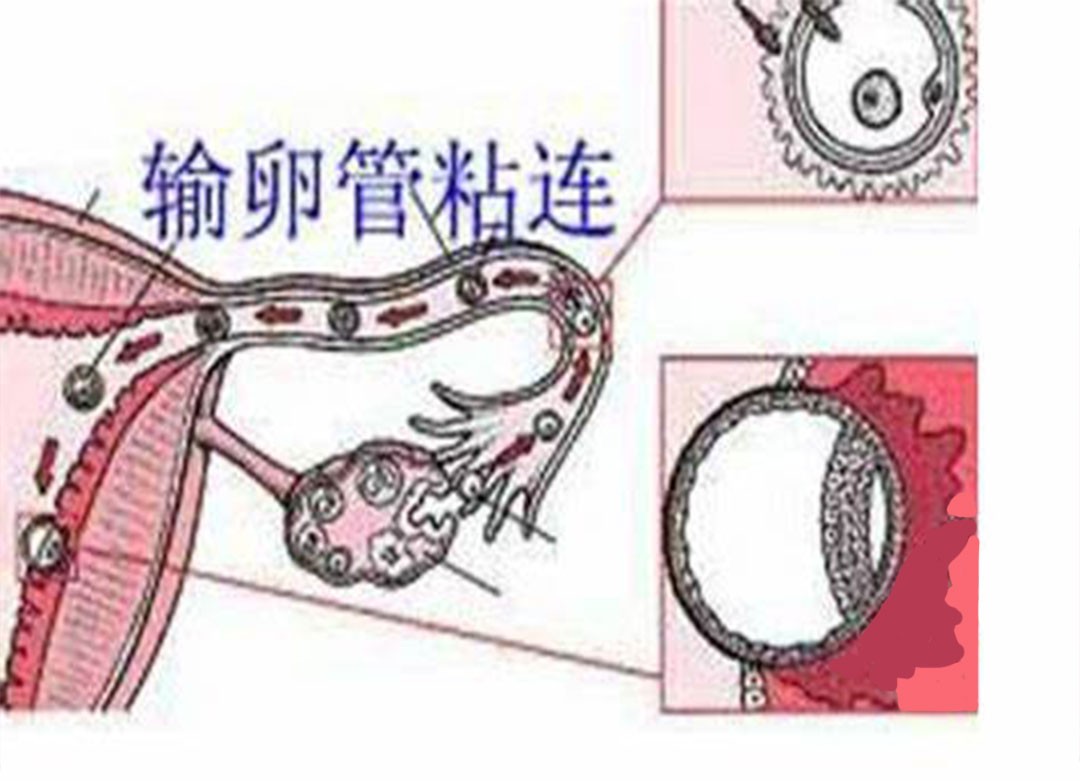 输卵管不孕是怎么回事?一篇文章搞懂输卵管不孕