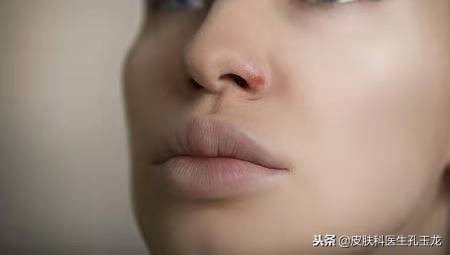 嘴唇长疱疹是哪里上火了,嘴唇上火起泡和单纯疱疹怎么区别