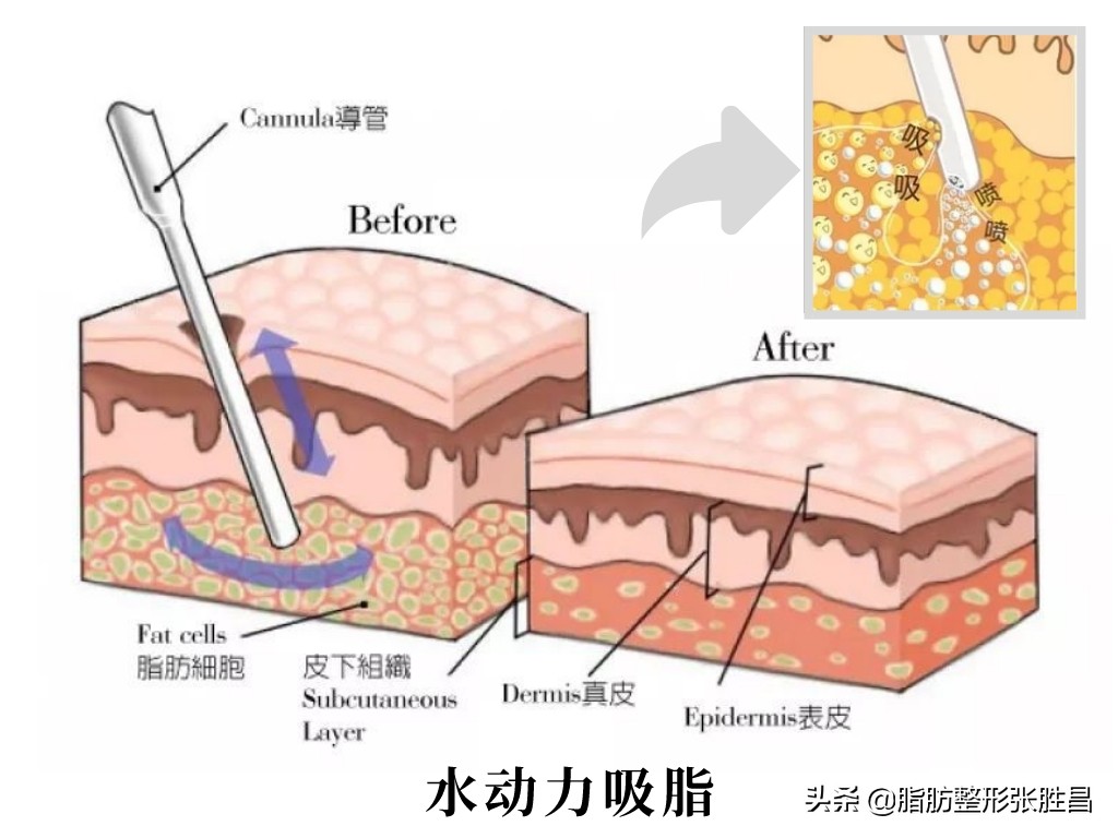 真的有边吸脂边提升的吸脂方法吗,吸脂手术的四大误区