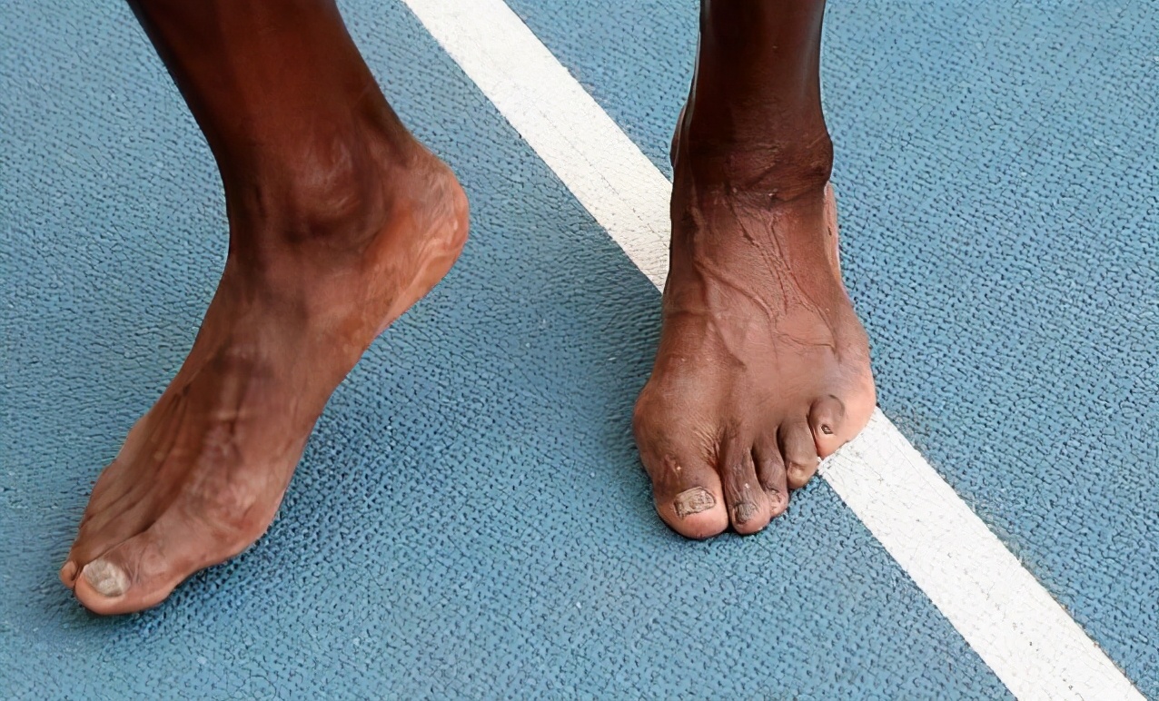 博尔特为什么肩膀晃动,博尔特左右腿不一样长是什么病