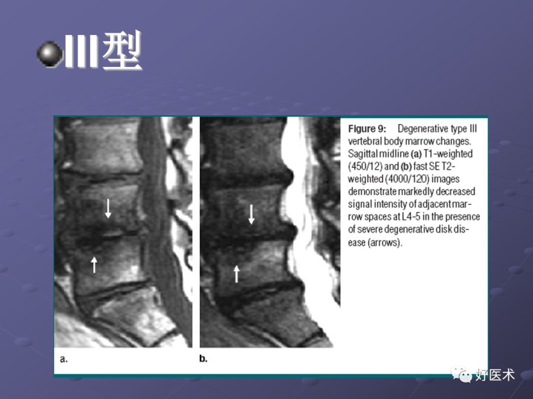 脊柱mri有哪些特点,乳腺疾病的mri诊断及鉴别