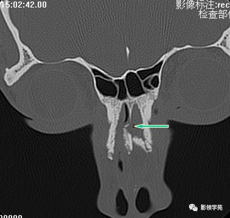 鼻骨骨折的检查方法,鼻骨骨折影像学表现