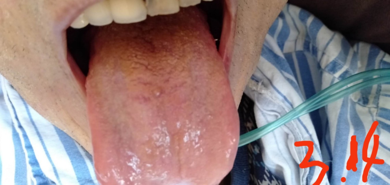 中西医结合治疗原因不明肠梗阻、腹水转氨酶明显升高病案一例！