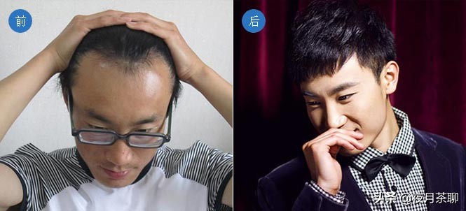 发际线太高怎么办一招解决,有人说我发际线高怎么办