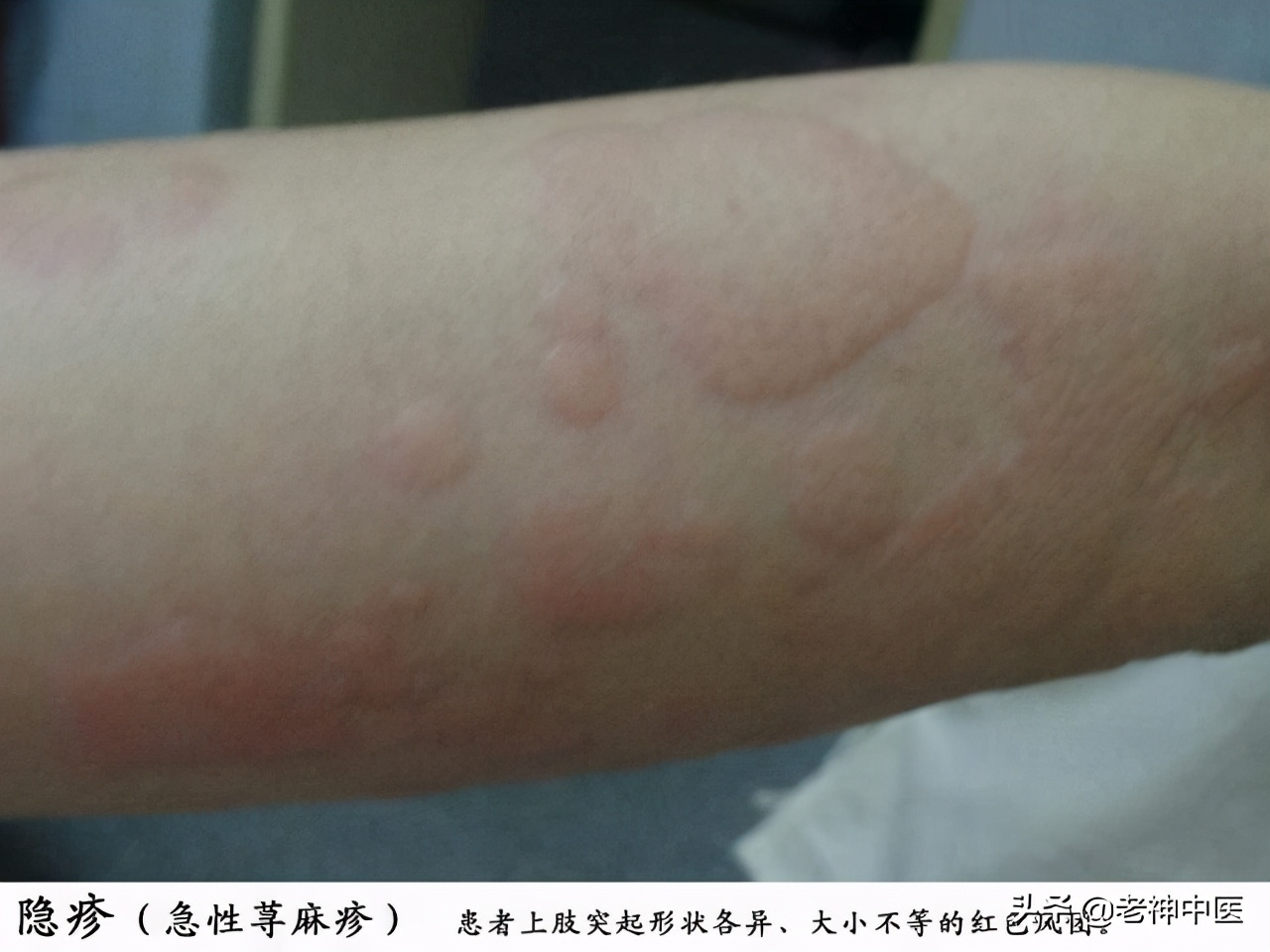 顽固性荨麻疹中医疗法,麻疹反反复复最快治疗方法