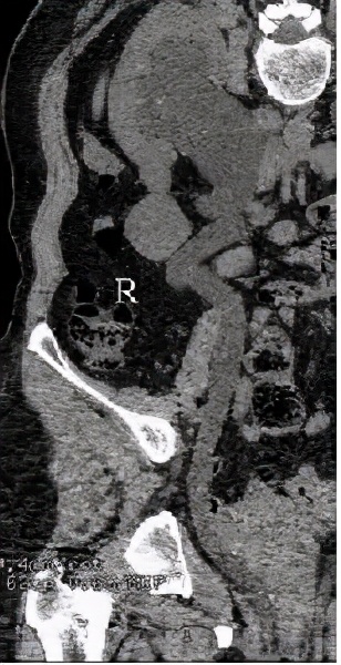 尿路梗阻导致肾积水不及时治疗,双肾积水是尿路梗阻吗