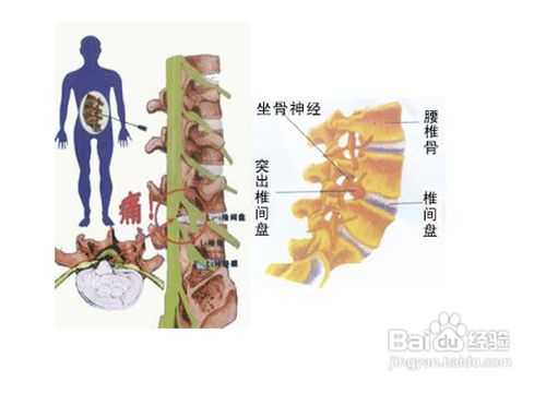 腰椎间盘突出会引起哪里肌肉萎缩,腰椎狭窄突出会导致腿部肌肉萎缩