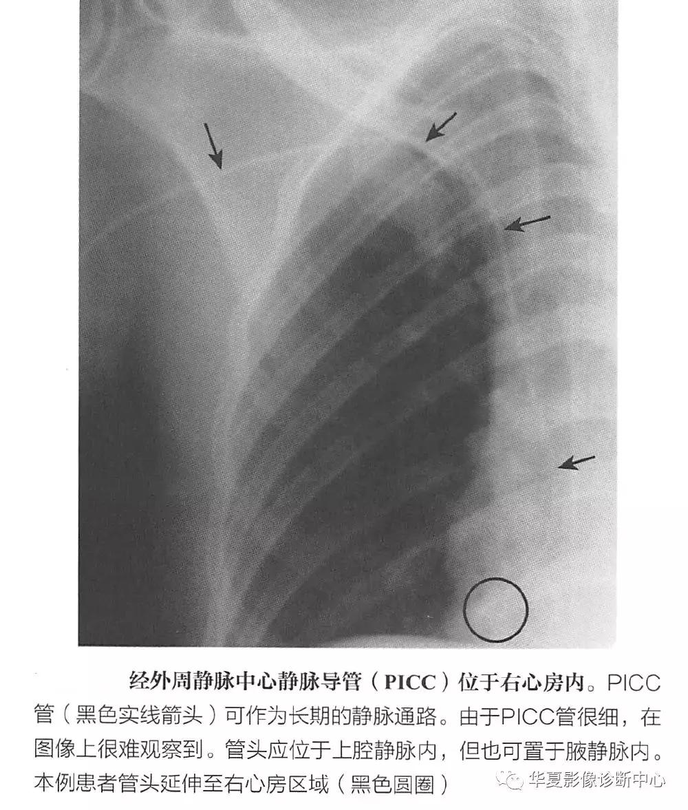 胸部x线影像与诊断基础,胸部置管