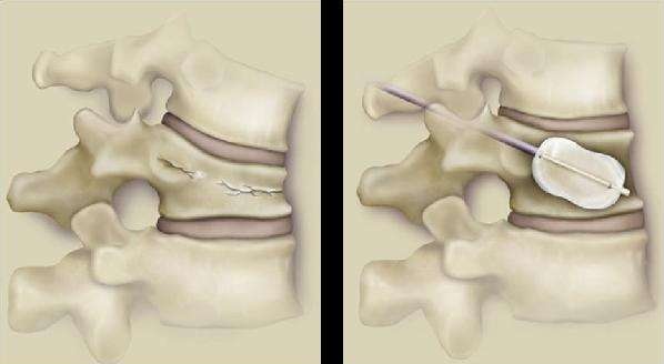 压缩性骨折做骨水泥微创,骨质疏松压缩性骨折打骨水泥