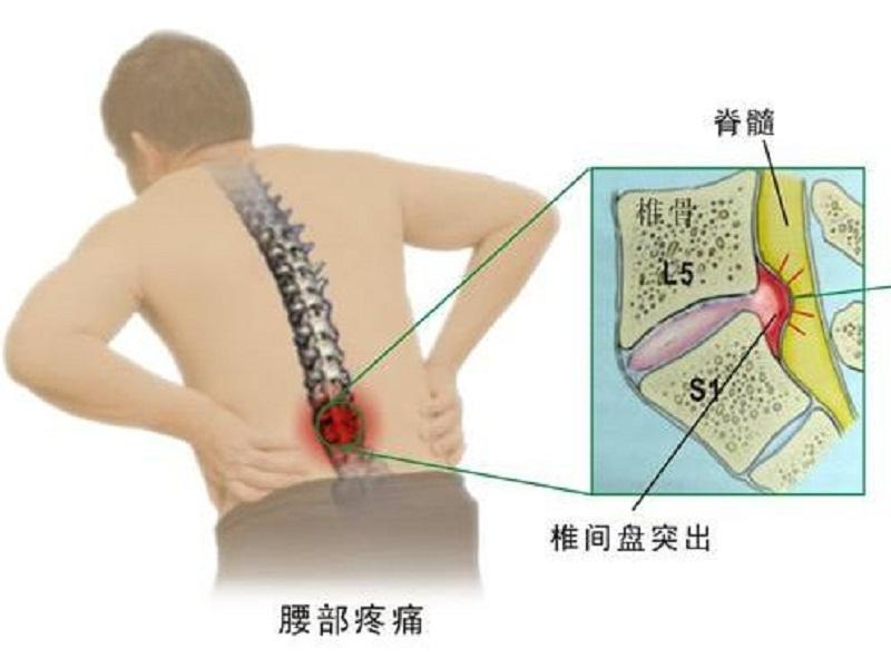 腰间盘突出膨出脱出是什么意思,腰椎间盘突出脱出膨出的区别