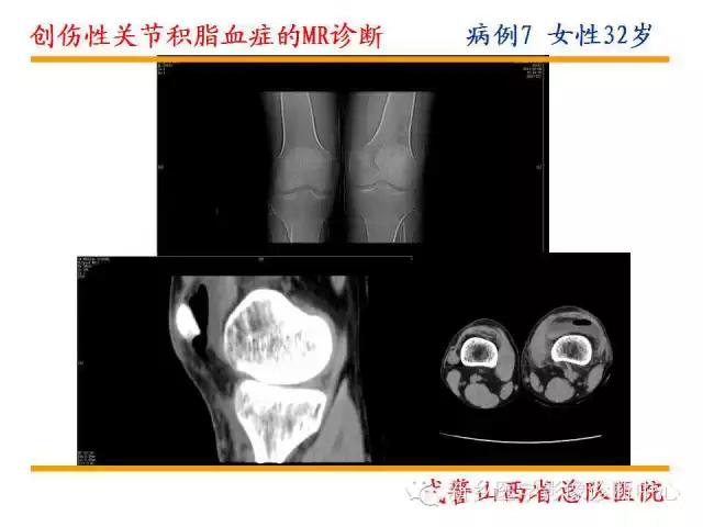 膝关节炎髌上囊积液自己看得出吗,髌上囊有积液膝盖会走路无力吗