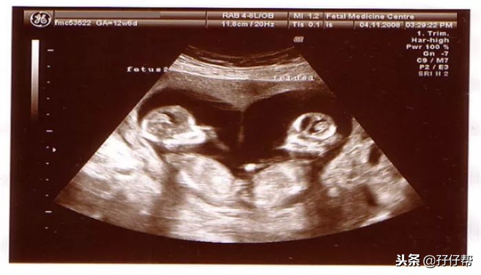 12周双胎,孕12周孕妈妈会有什么感觉