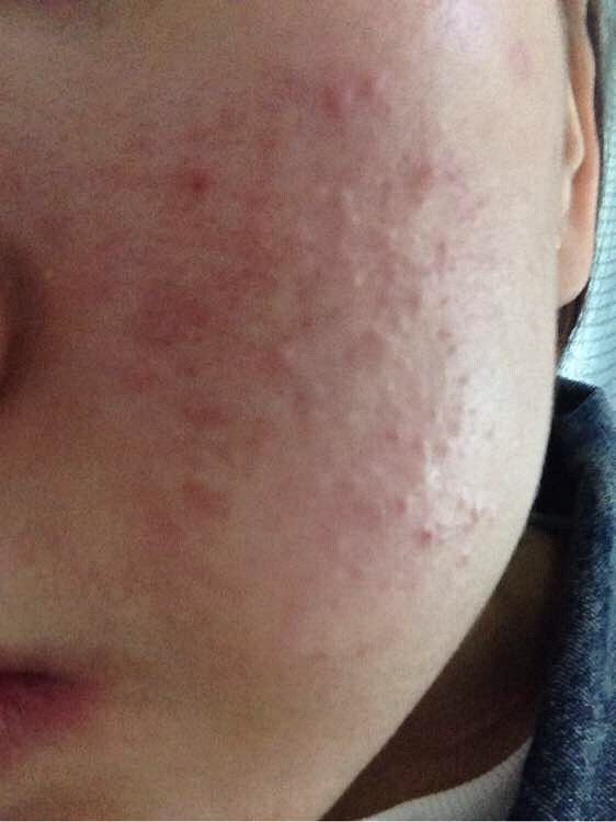 激素治疗过敏后遗症,断激素药有什么反应