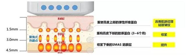面部线雕跟超声刀哪个好,超声刀线雕和拉皮哪个效果好
