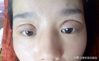 双眼皮多宽好看,双眼皮多宽才好看图片