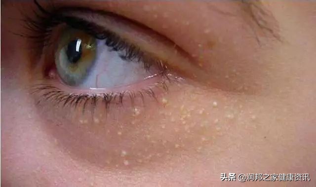 爱长脂肪粒适合用哪种眼霜,用了雅诗兰黛眼霜长脂肪粒