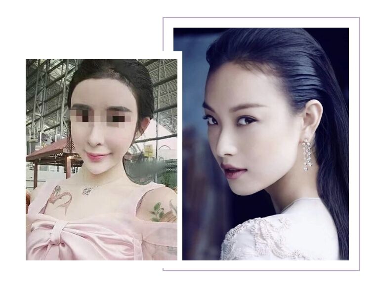 关于瘦脸的知识,关于瘦脸针