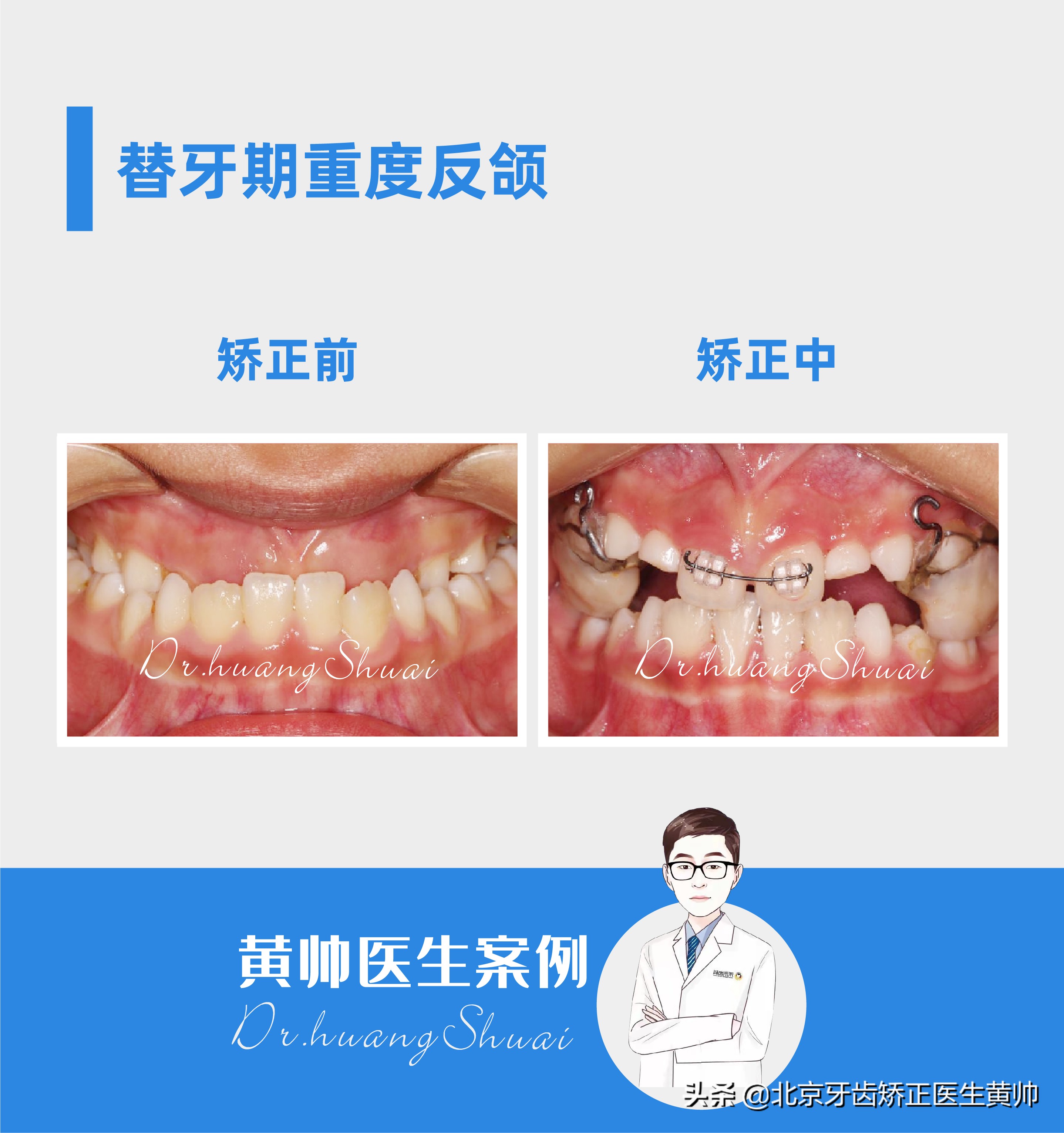 腺样体肥大牙齿矫正最佳年龄,儿童龅牙牙齿矫正最佳年龄