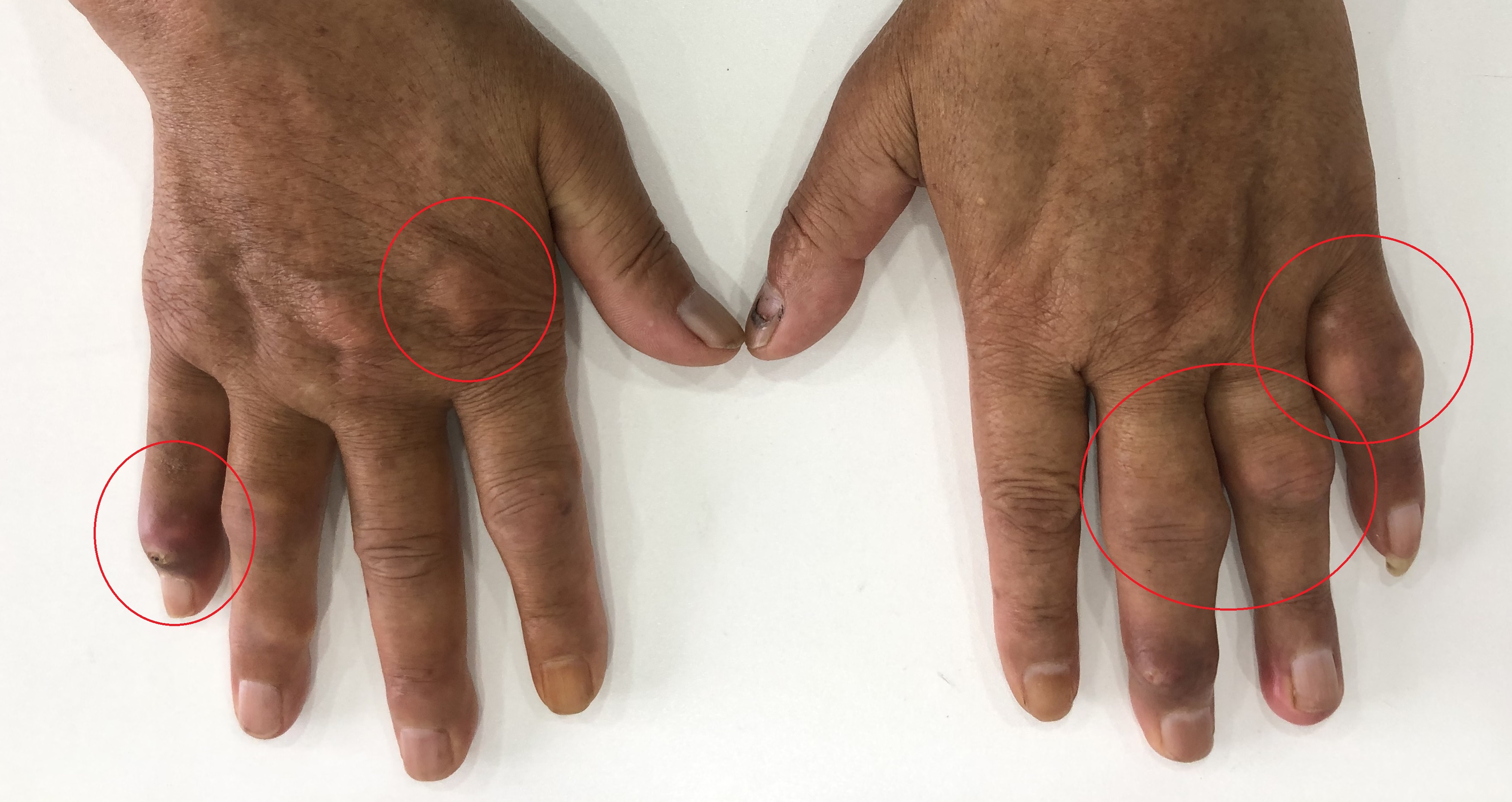 风湿病如何锻炼身体,在家怎样自己调理风湿类风湿教程