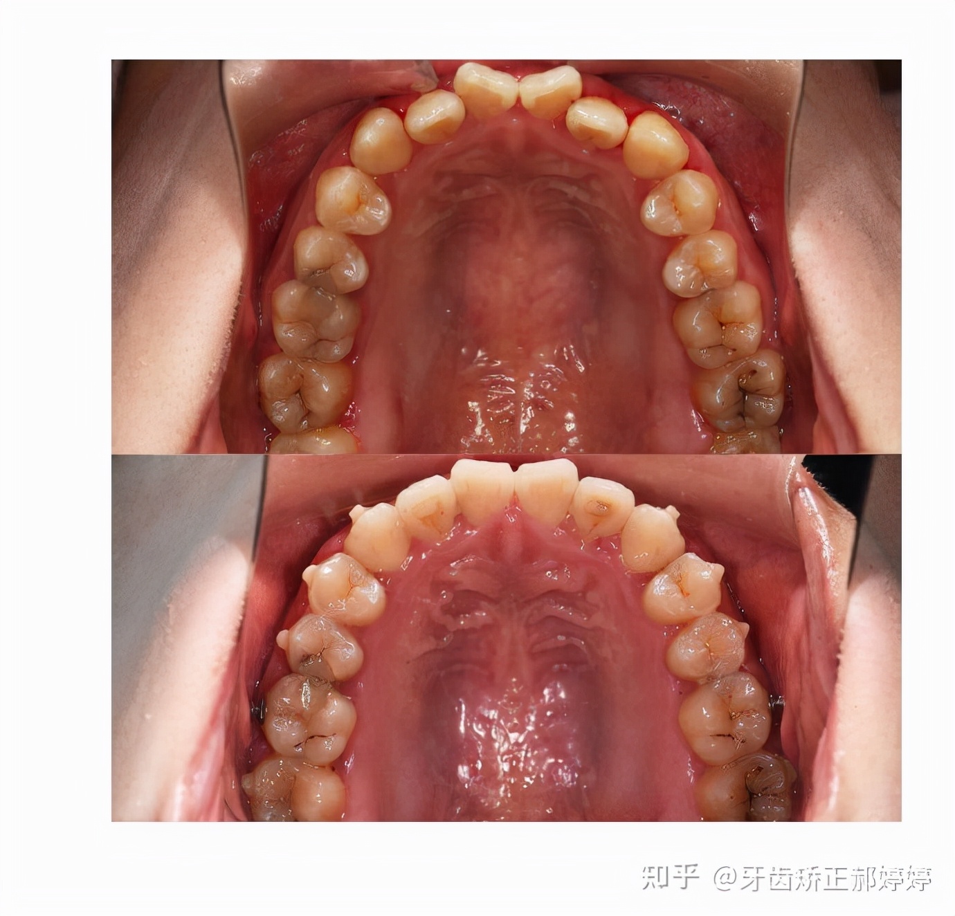 上海成人牙齿矫正失败案例,上海牙齿矫正郝婷婷医生