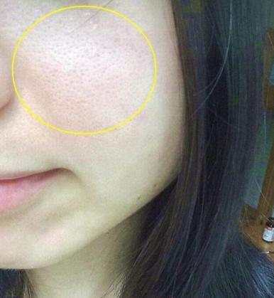 螨虫钻进皮肤怎么办,螨虫钻入背部毛囊怎么办