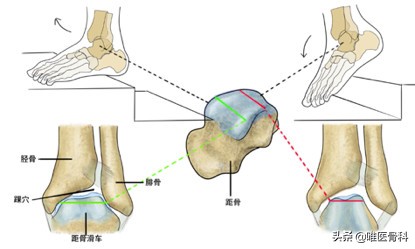 骨科医生崴脚怎么办,严重崴脚怎么止痛