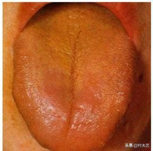 舌苔与疾病对照表详细,舌苔黑是什么疾病产生