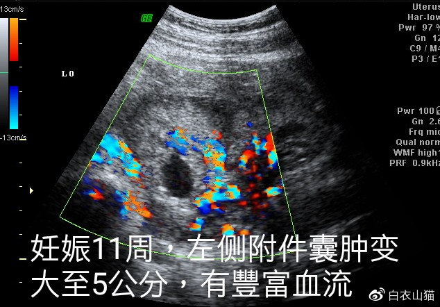 双胞胎，一个在宫内，一个躲宫外。孕妈生命垂危，医生妙手回春！