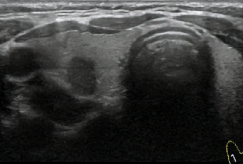 回声略粗和稍粗哪个严重,回声均匀好还是不好