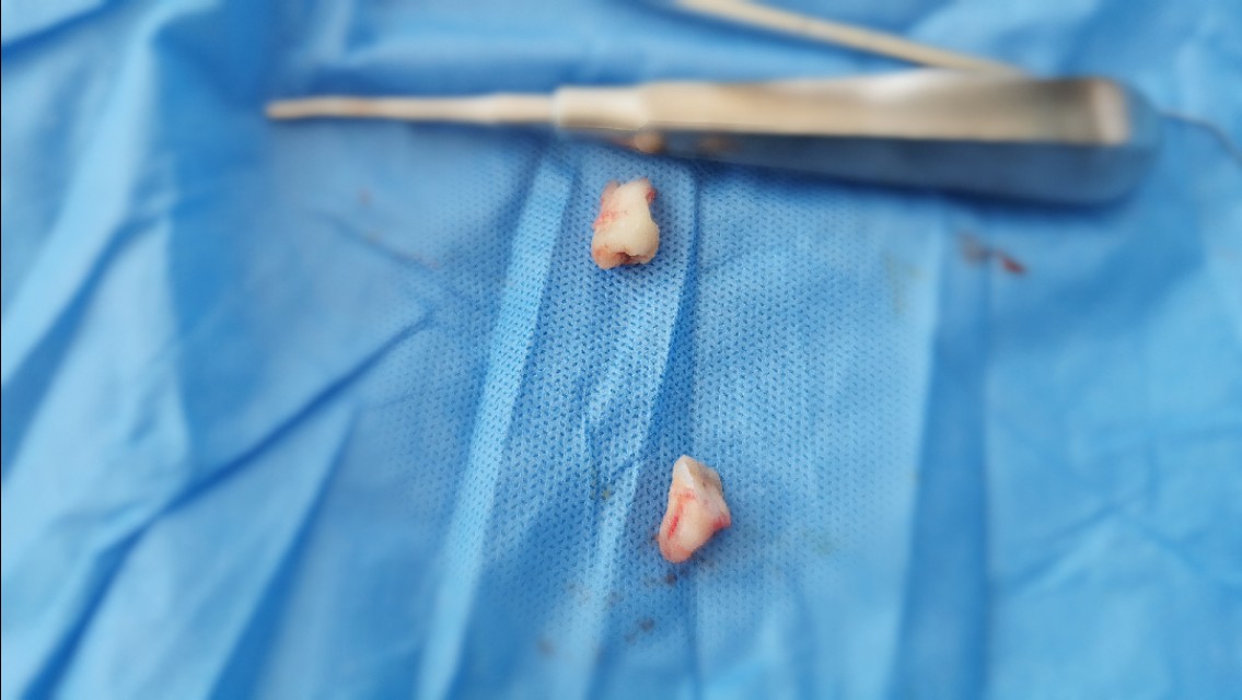 杭州口腔拔牙,杭州口腔嘉兴分院拔牙