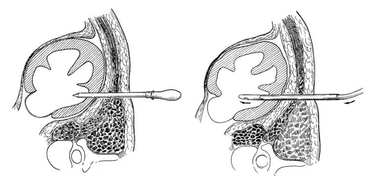 经皮肾穿刺造瘘术是微创吗,超声引导下经皮肾穿刺造瘘