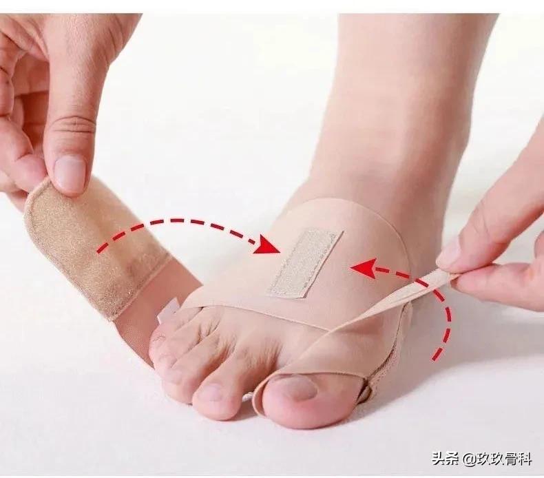 女人的烦恼大全,女朋友有拇外翻怎么办