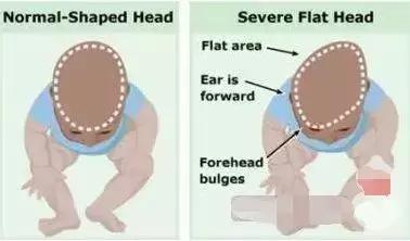 让孩子睡出完美头型的五个方法,小孩头型睡偏了几岁前能睡过来