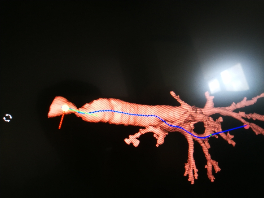 经支气管镜球囊扩张治疗气道狭窄,支气管镜球囊扩张操作视频