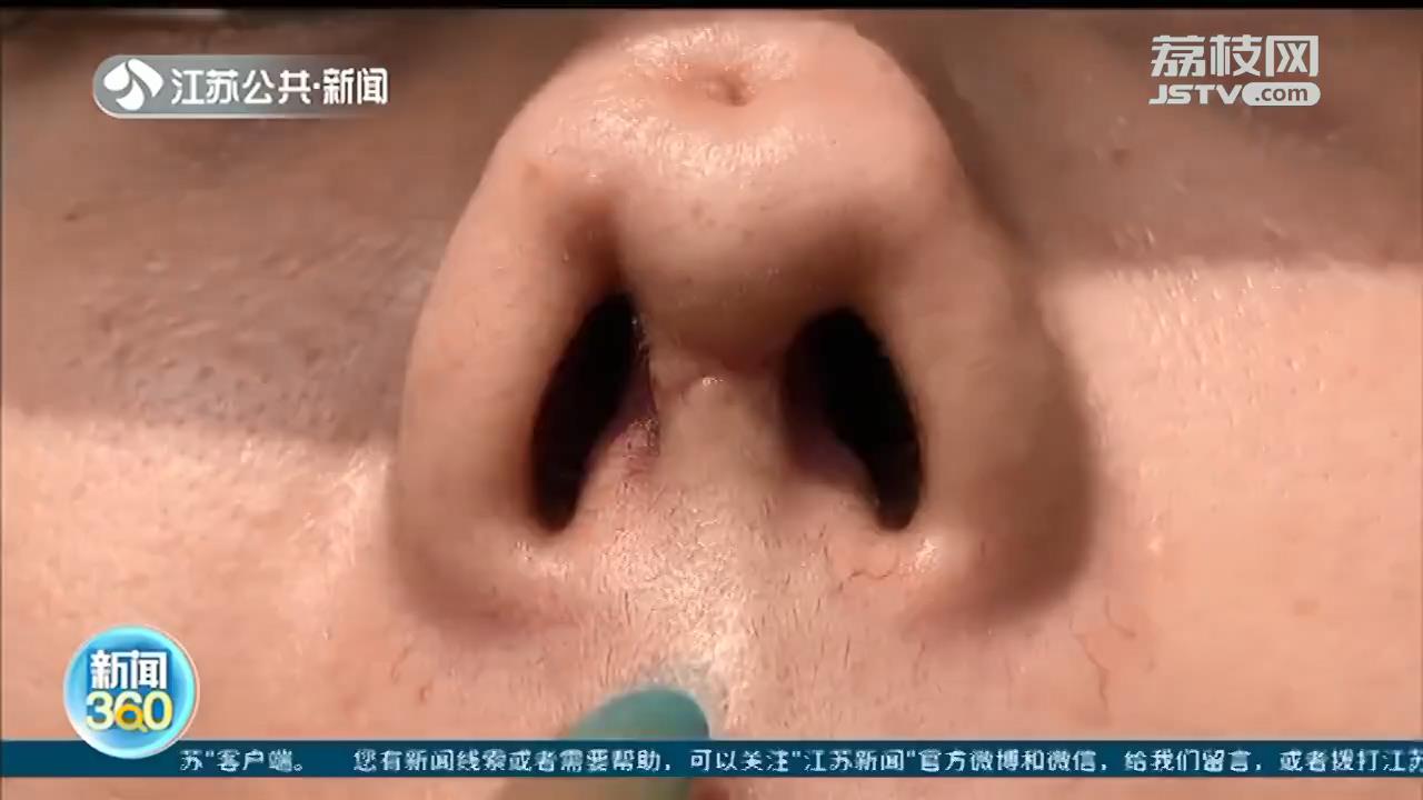 隆鼻修复失败的女主播是谁,女主播做隆鼻修复