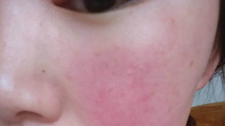 换护肤品过敏后用什么修复敏感,敏感肌为啥一用护肤品脸部就发红