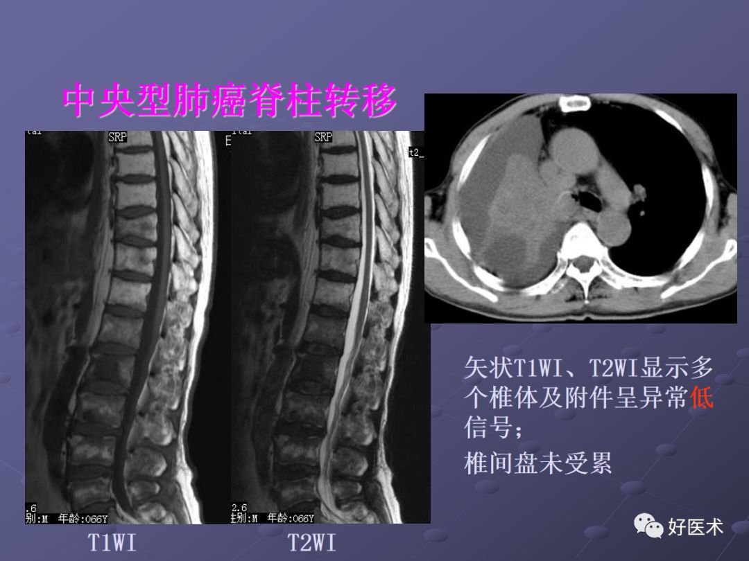 脊柱mri有哪些特点,乳腺疾病的mri诊断及鉴别