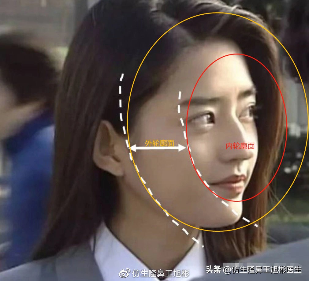 鼻整形后鼻头大,鼻整形后脸小了