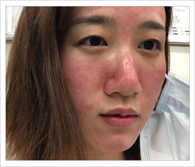 脸上螨虫的正确消灭方法,脸上的螨虫能不能彻底消灭