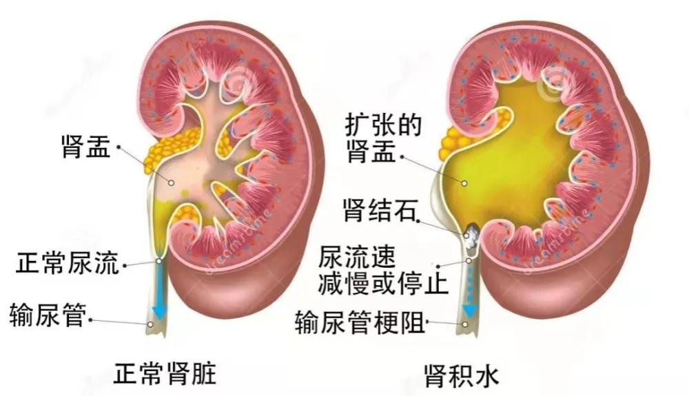 小结石有可能引起潜血吗,小结石引起的肾积水要紧吗